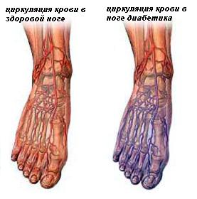 Развитие диабетической ангиопатии