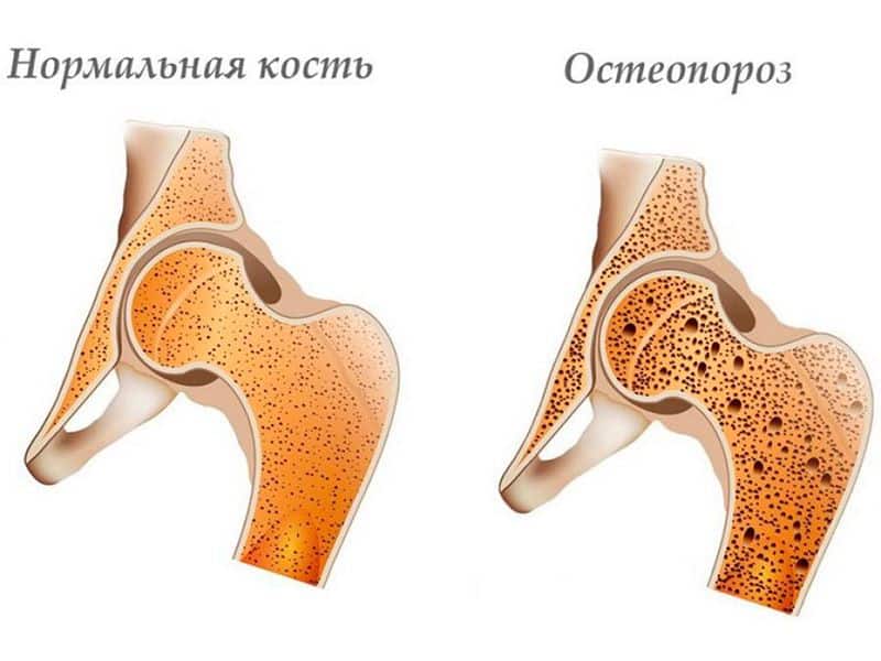Развитие остеопороза