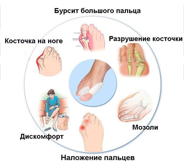 Развитие вальгуса