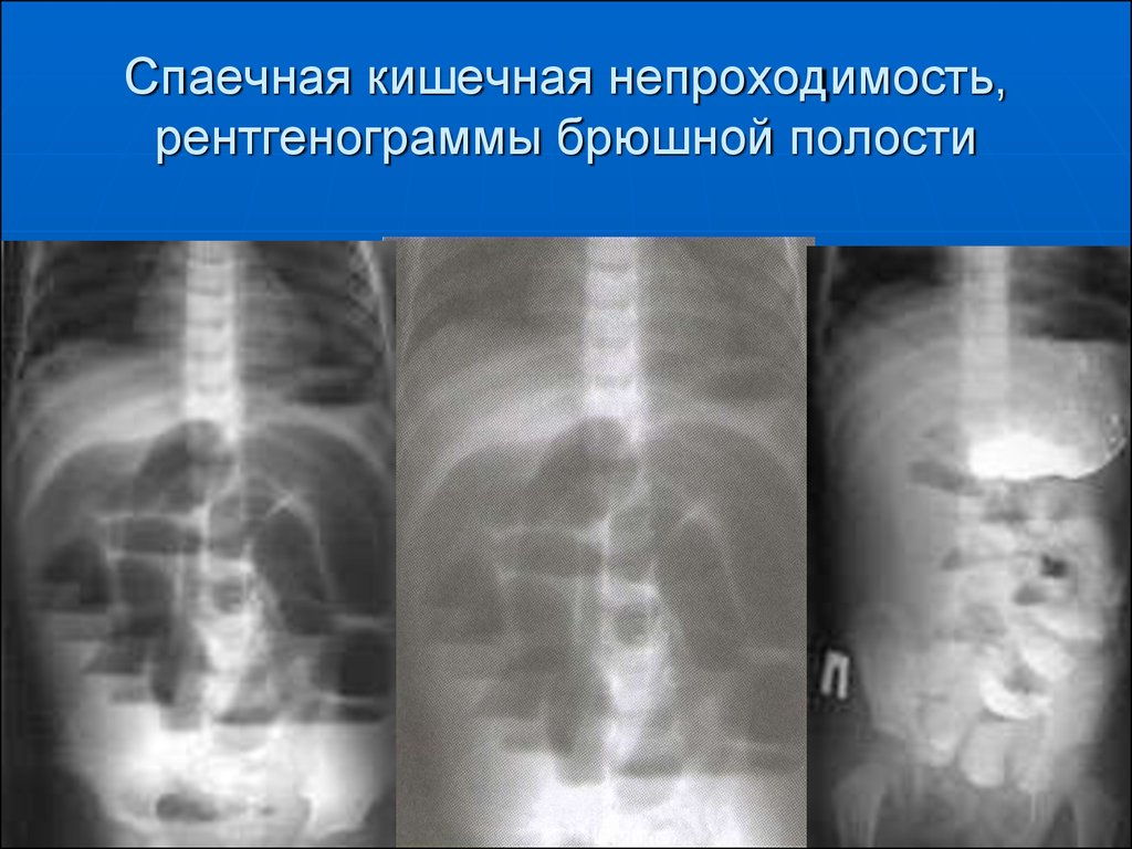 Рентгенологическая картина при кишечной непроходимости