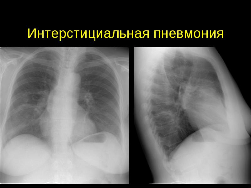 Рентгенологическое изображение лёгких