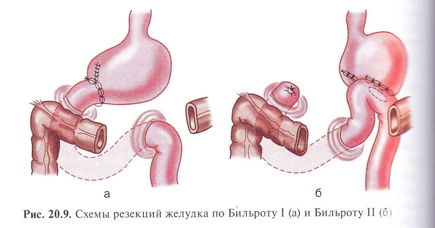 схема резекции желудка