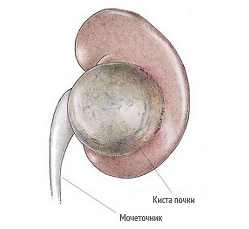 Крупная киста почки