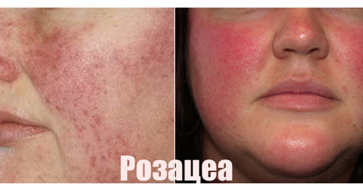 Розацеа