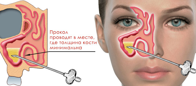 пункция гайморовой полости