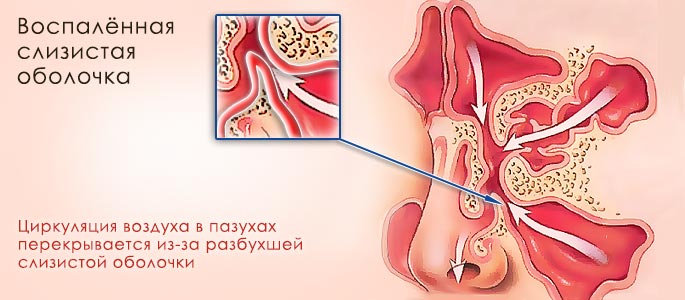 катаральный гайморит