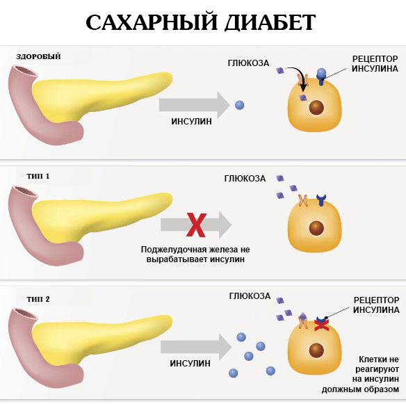 Сахарный диабет 1 и 2 типов (схема)