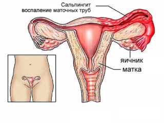 Сальпингит