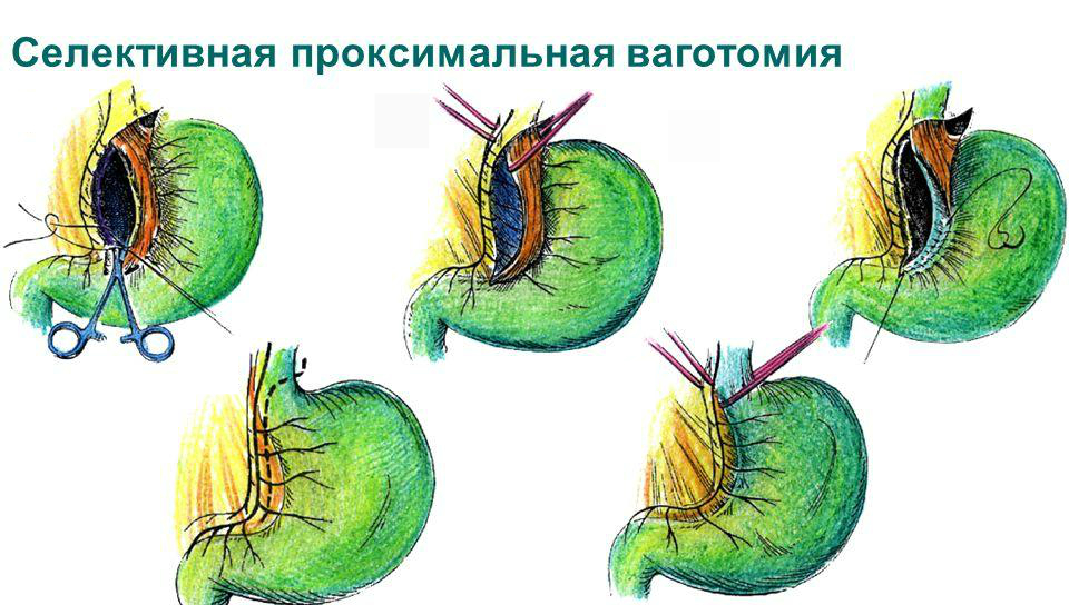 Селективная проксимальная ваготомия