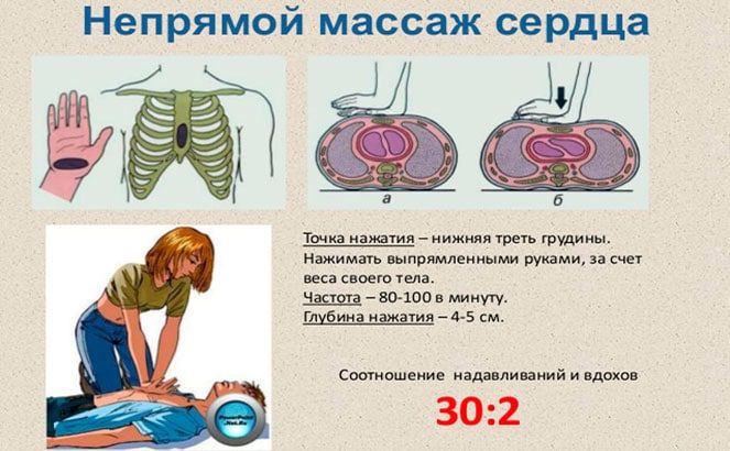 Схема алгоритма выполнения непрямого массажа сердца