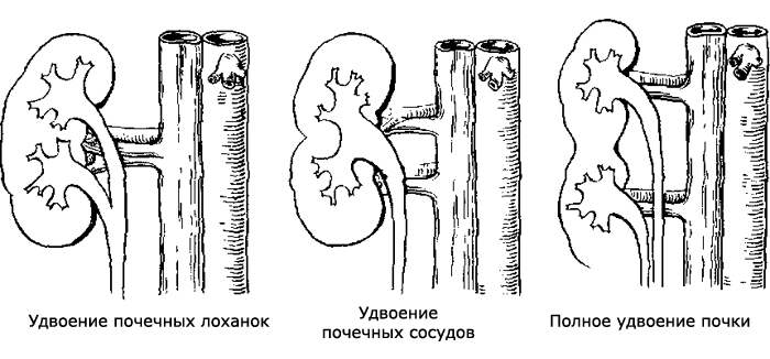 Схема аномалий строения почек