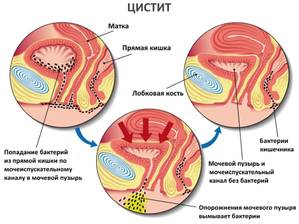 Схема цистита