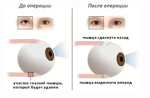 Схема хирургического лечения при косоглазии