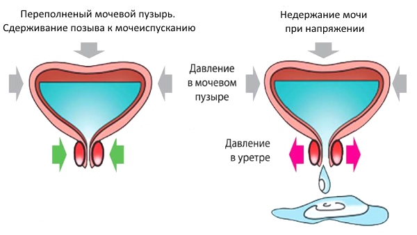 Схема недержания мочи