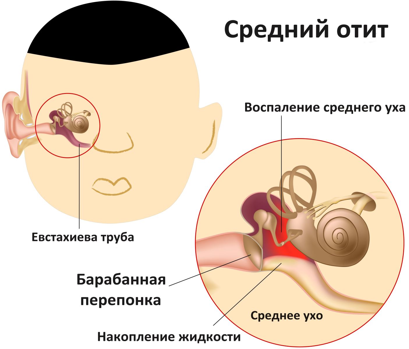 Схема отита среднего уха