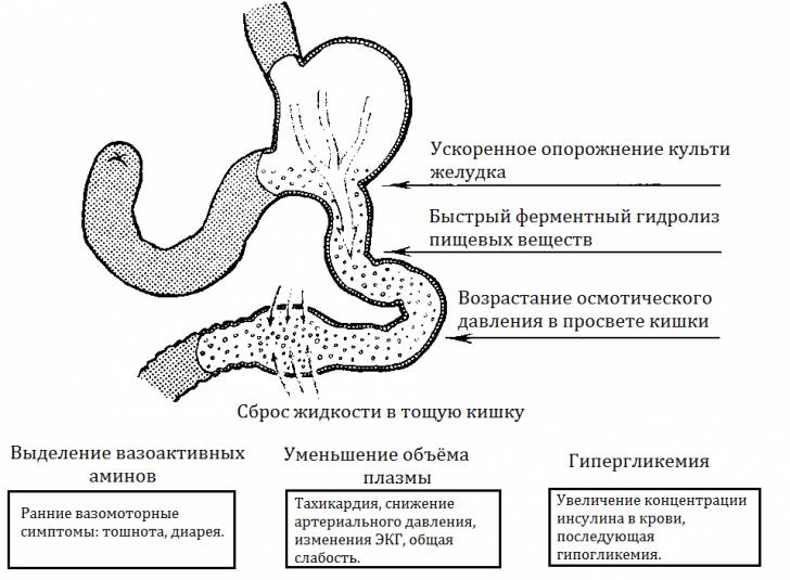 Схема развития демпинг-синдрома