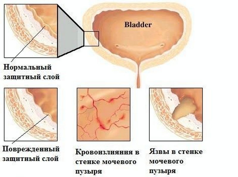 Схема развития лучевого цистита в результате облучения