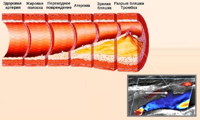 Схема стадий формирования атск-бляшки и УЗИ кровеносных сосудов с атеросклерозом