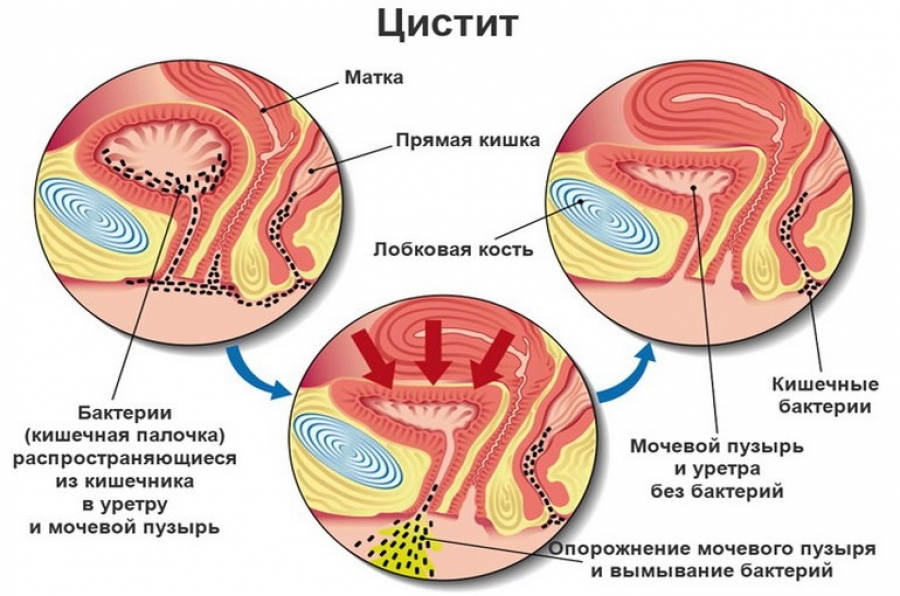 Схема возникновения цистита