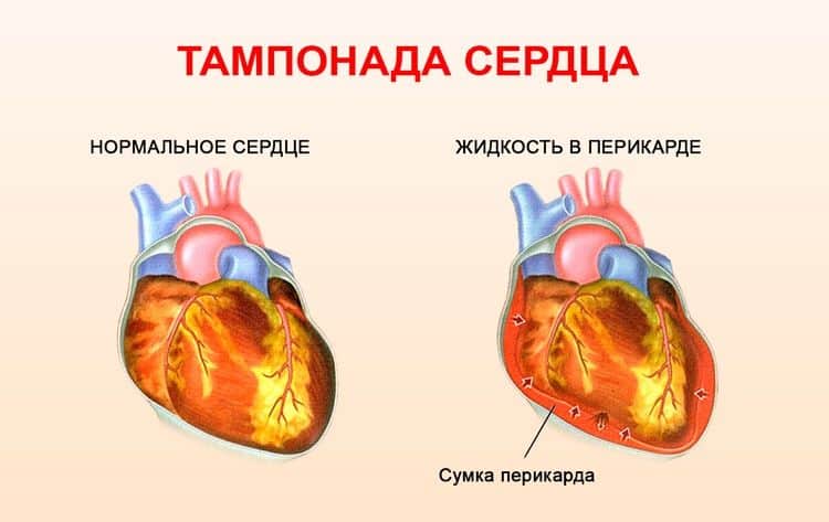 Схематическое сравнение нормального состояния сердца и тампонады
