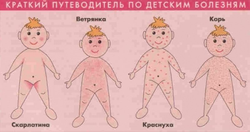 Локализация сыпи на теле при краснухе, скарлатине, ветрянке, кори
