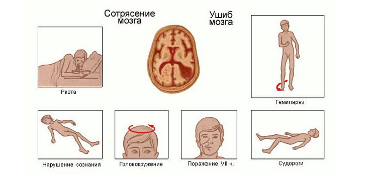 Симптомы черепно-мозговой травмы