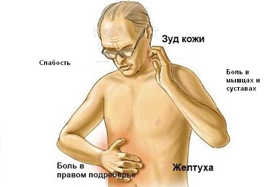 Симптомы гепатита Е