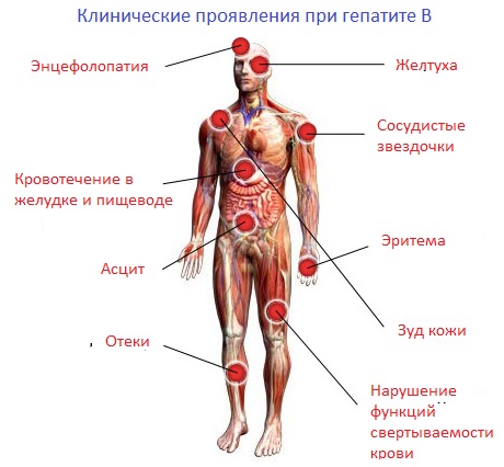 Симптомы хронического гепатита В