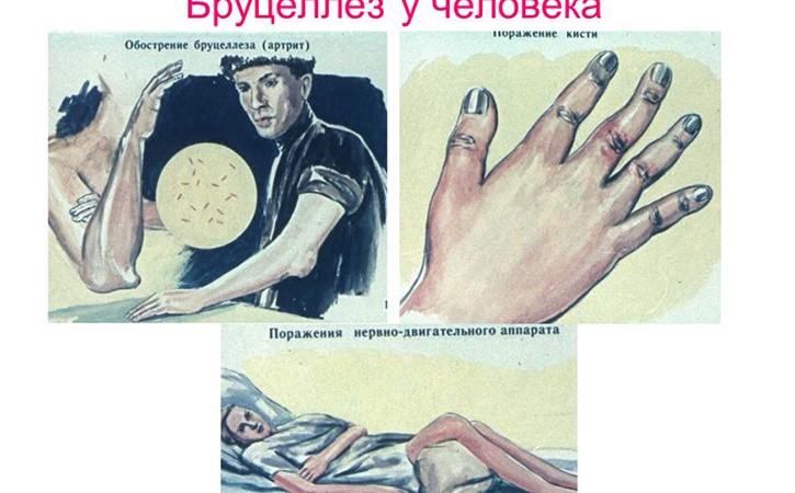 Симптомы обострения хронического бруцеллёза