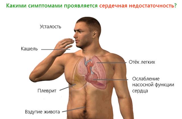 Симптомы сердечной недостаточности