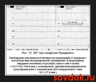синдром Фредерика