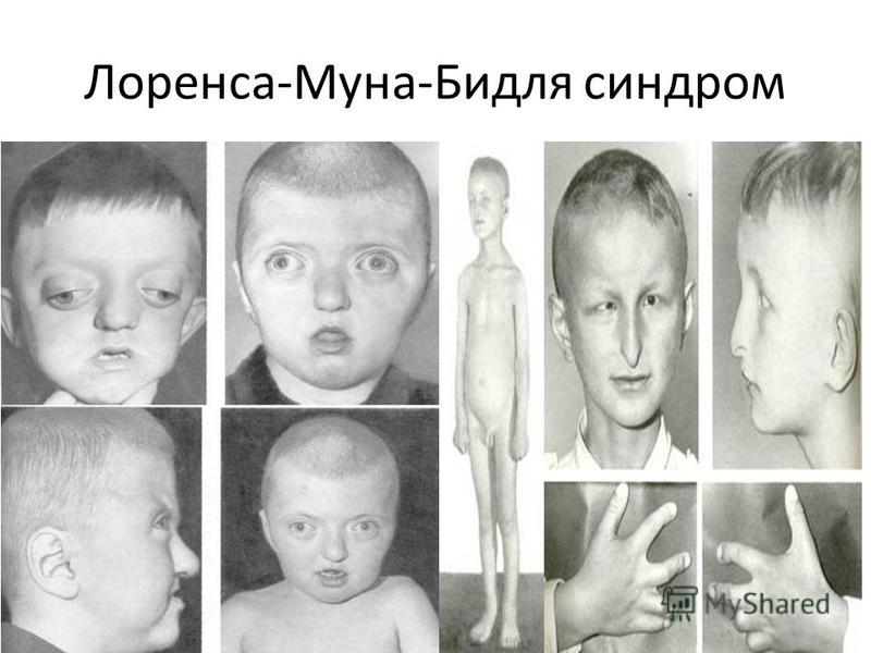 Синдром Лоренса-Муна-Бидля