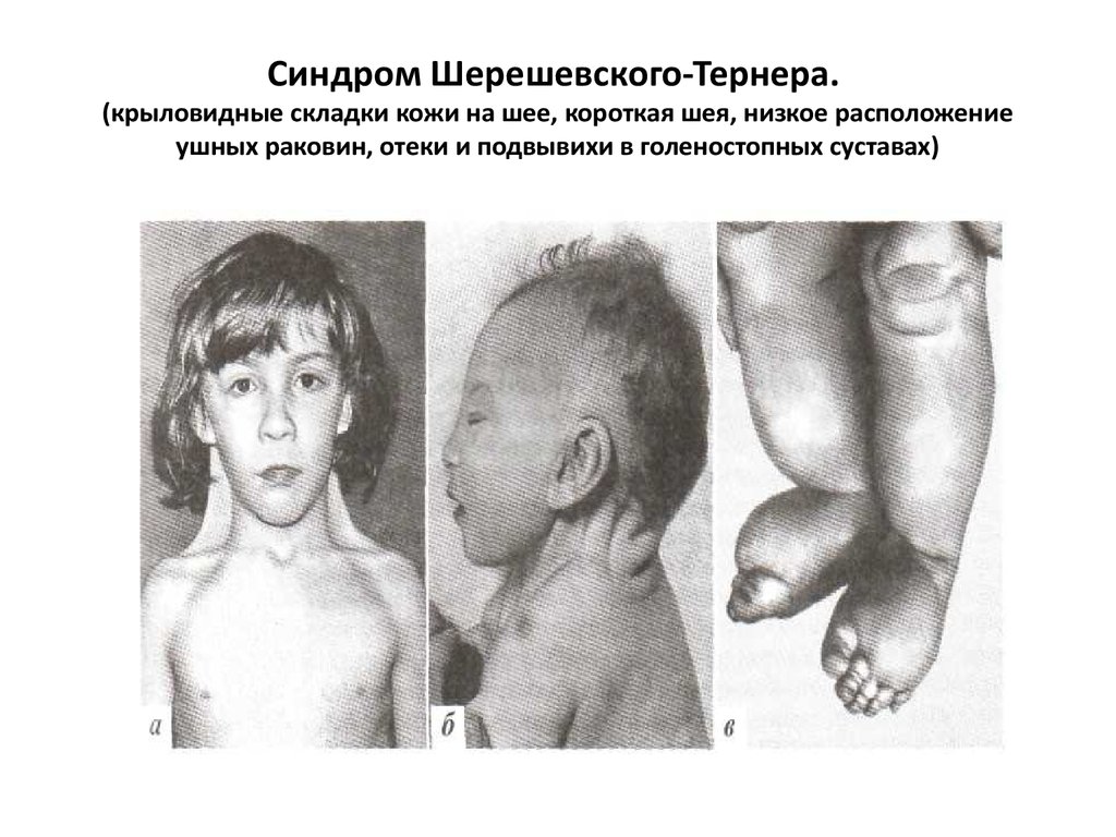 Синдром Шерешевского-Тёрнера