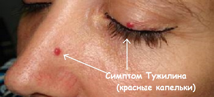 Диагностика и лечение синдрома Тужилина