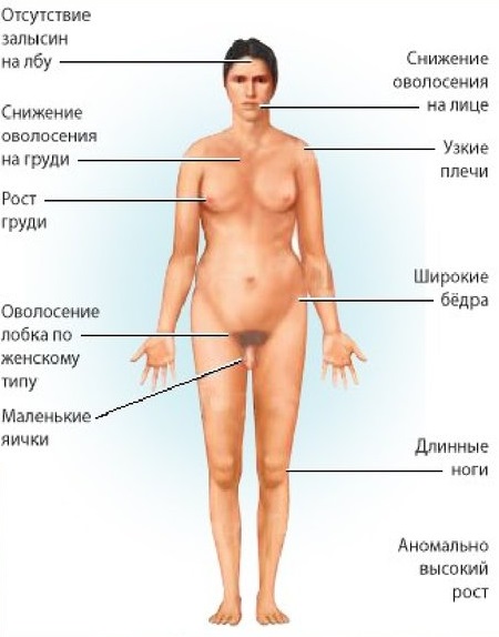 Синдром Клайнфельтера