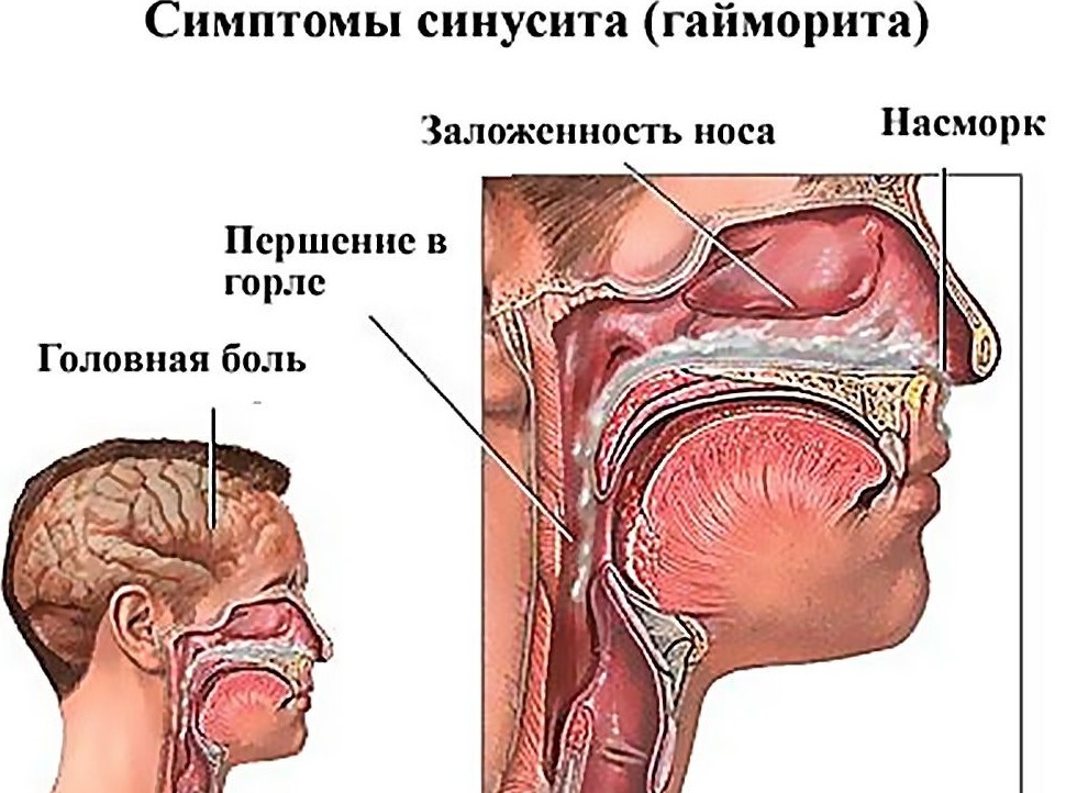 Схема симптоматики синусита
