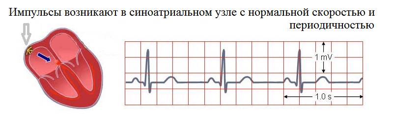 Синусоидный ритм сердца – норма на ленте ЭКГ