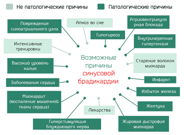 Синусовая брадикардия, как следствие воздействия отрицательных факторов
