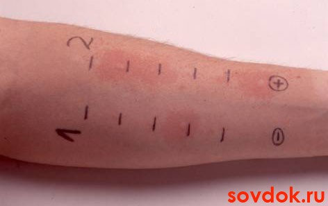 скарификационные тесты