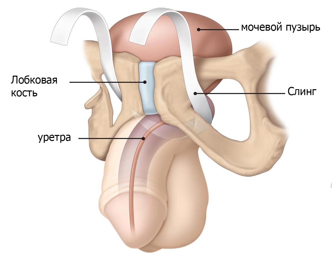 Слинговая операция на схеме