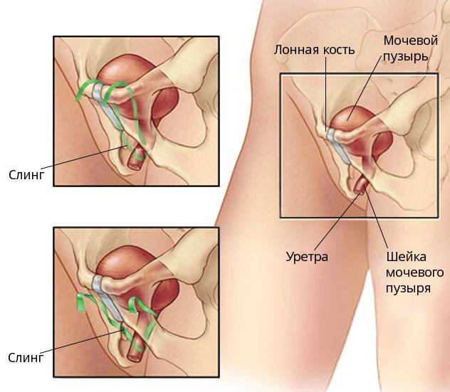 Слинговая операция