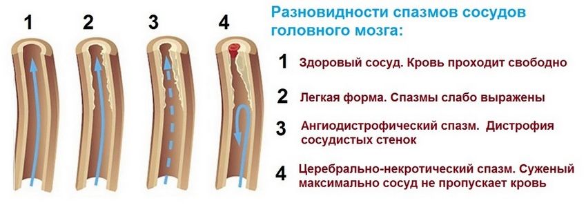 Спазм сосудов головного мозга