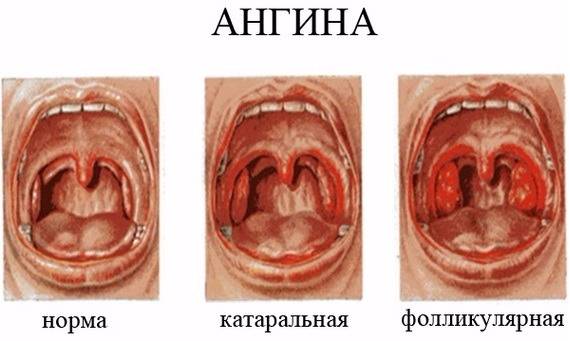 сравнение фолликулярной и катаральной форм ангины