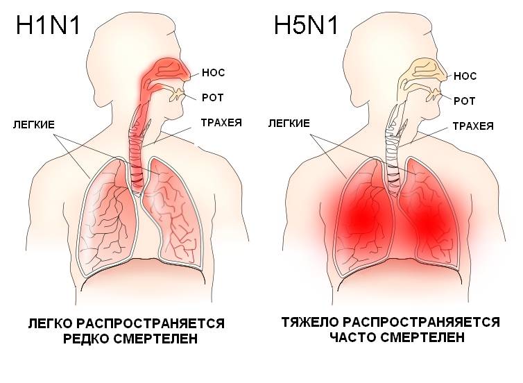 Сравнение клинической картины обычного гриппа и птичьего