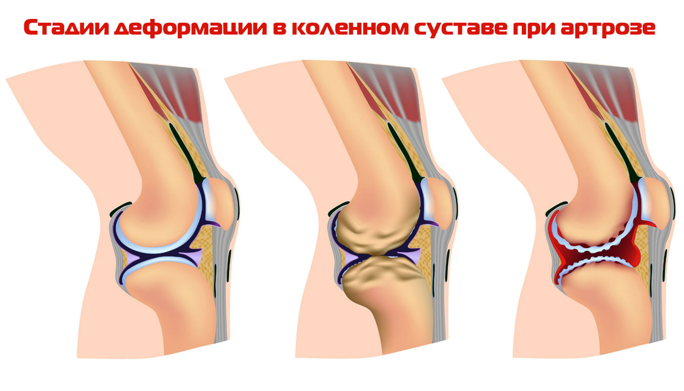 Стадии дегенерации хряща коленного сустава