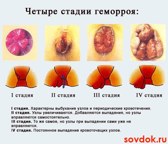 стадии геморроя