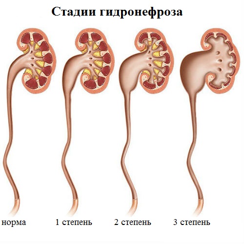 Стадии гидронефроза