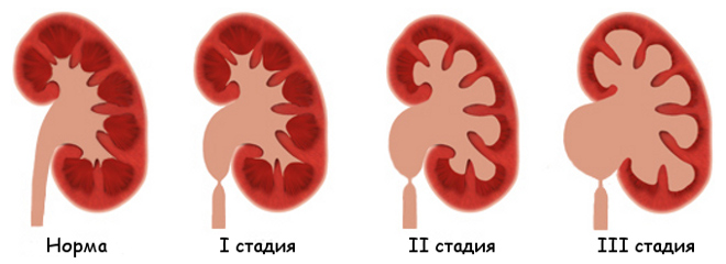 Стадии пиелоэктазии