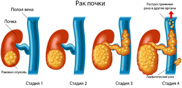 Стадии рака почек