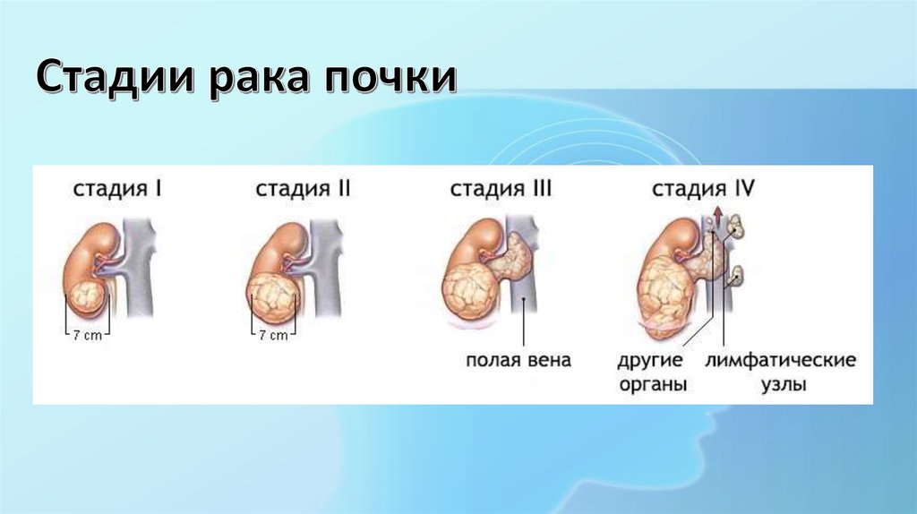 Стадии рака почки